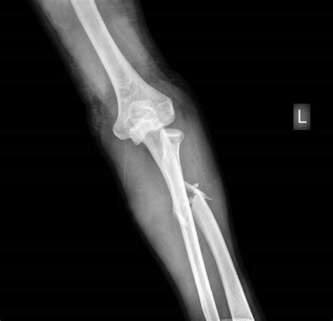 Best X Ray Image Of A Broken Arm Stock Photos Pictures And Royalty Free