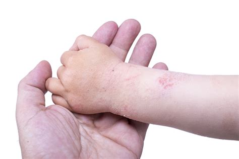 Eczema Atopic Dermatitis Gene Devora Md Allergy Asthma Care Plano Tx