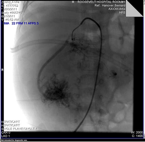 Angiogram Showing The Type Iii Michels Hepatolineogastric Pattern With