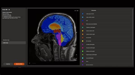 Siemens Healthineers Introduces Ai Based Assistants For Magnetic Resonance Imaging