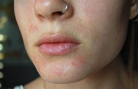 Perioral Dermatitis Treatment Causes And Symptoms Hickey Solution