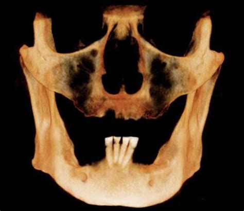 Sinus Lift Elevation Bone Grafts And Dental Implants