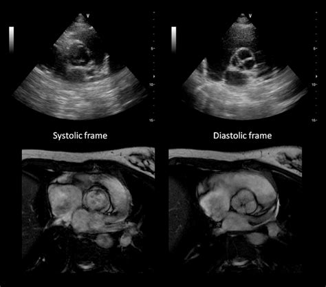Echocardiograpic And Mri Images Showing Quadricuspid Aortic Valve With