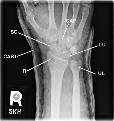 A Baseball Player With Right Wrist Pain
