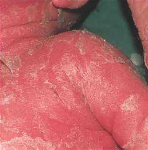 Healthoolstaphylococcal Scalded Skin Syndrome Rash Pictures Atlas Of