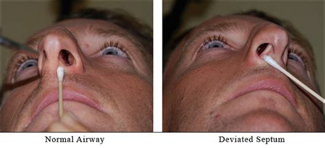 Deviated Septum Inside Nose