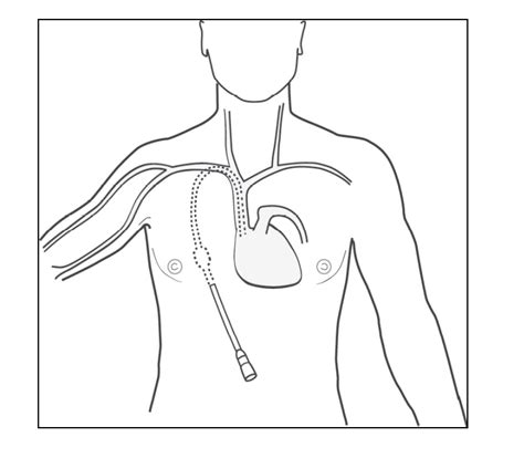 Dialysis Line Insertion Central Venous Access Cuh