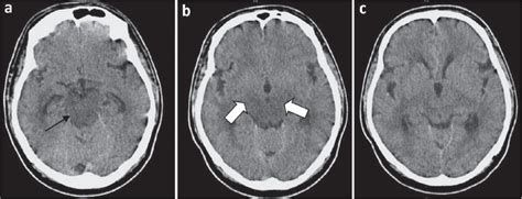 Hypertensive Brainstem Encephalopathy A Diagnosis Often Overlooked