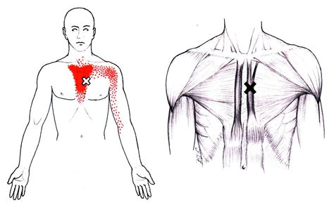 Rumpfmuskel The Trigger Point Referred Pain Guide
