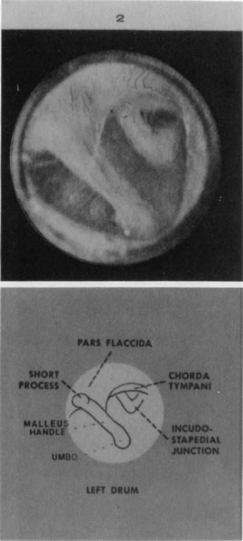 Normal Tympanic Membrane Left Ear From Abbott Laboratories See Fig