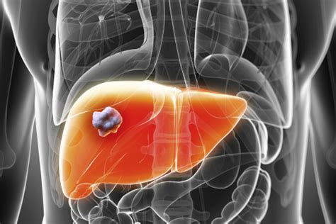 North South Divide Evident In Lifestyle Related Liver Disease Deaths