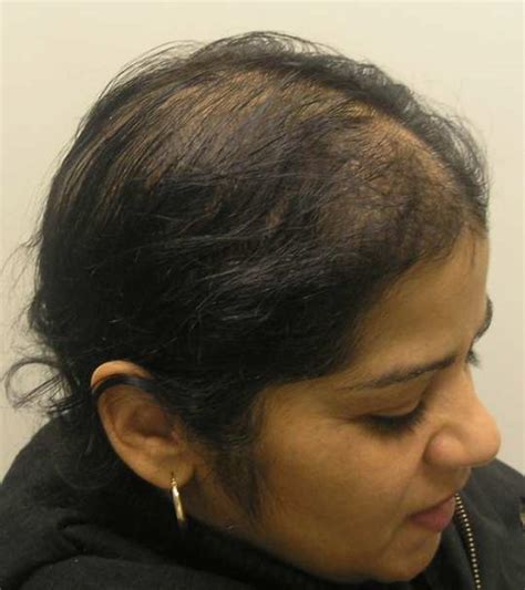 We take a look at finasteride before and after use and see if it cures hair loss and receding hairlines. Finasteride in Treatment of Female Hair Loss (2012)