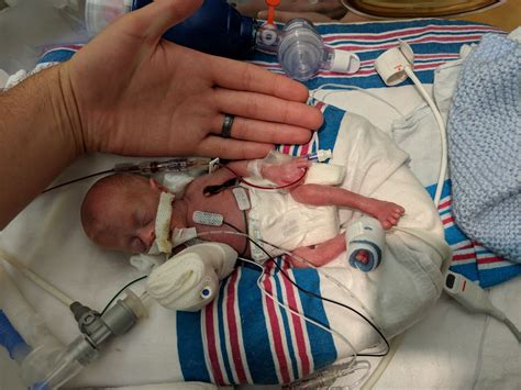 Miracle Baby One Of The Smallest Premature Infants Ever Heads Home