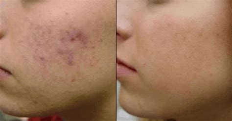 Whats The Best Way To Get Rid Of Acne Overnight Best Acne Scar