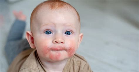 What Is Allergy In Children 5 Common Types Of Allergies In Children