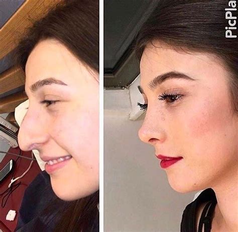 Possibly The Best Nose Job Ive Ever Seen Nose Job Nose Surgery