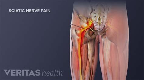 Nerve Pain In The Leg