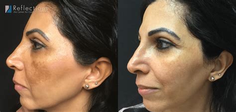 This medicine is a common first treatment for melasma. Melasma Laser Treatment for Woman Whose Melasma Was Made ...