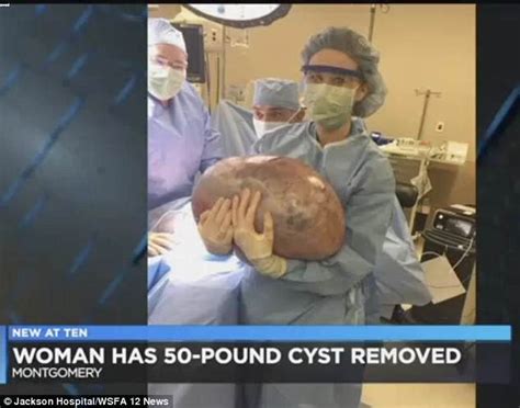 alabama woman has has fifty pound cyst removed from her ovary daily mail online