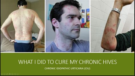 What I Did To Cure My Chronic Idiopathic Urticaria Chronic Hives