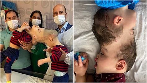 Conjoined Twins With Fused Brains Successfully Separated With Help Of