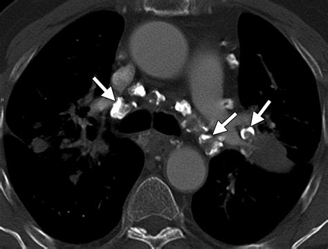 Sarcoidosis Lung Ct Scan
