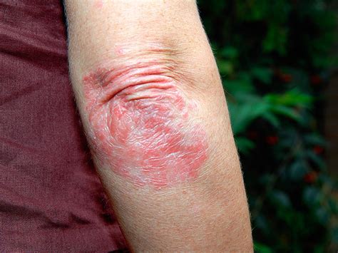Skin Manifestations In Acute Arsenic Poisoning