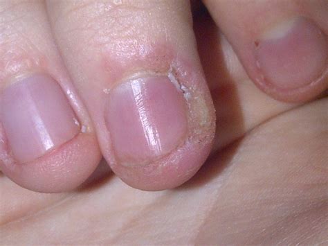 Skin Peeling Around Nails Causes And Treatments Enkivillage