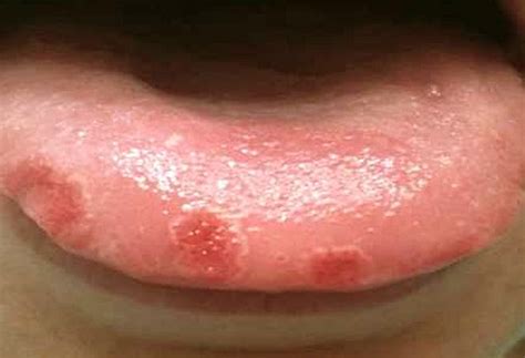 Bumps On Tongue Pictures Causes Treatment How To Deal