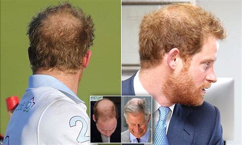 Harrys Facing The Bald Truth Prince Phillip Prince Charles Duchess