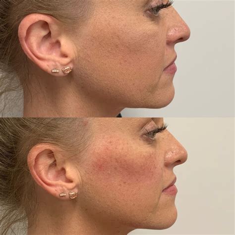 Cheek fillers are a safe and effective way to lift and sculpt your cheekbones. Cheeks, baby cheeks! Cheek fillers are one of my favorite ...