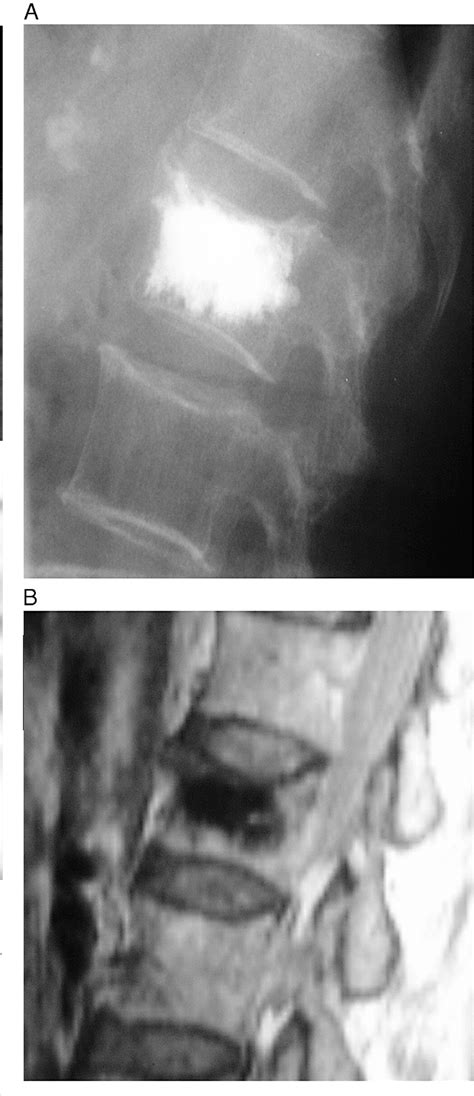Figure From Use Of Percutaneous Vertebroplasty For Intractable Back