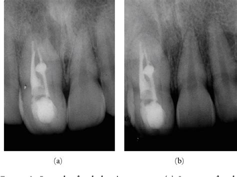 Figure From Conventional Treatment Of Maxillary Incisor Type III Dens