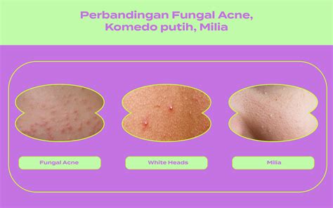 Serupa Tapi Tak Sama Perbedaan Fungal Acne Komedo Putih Dan Milia