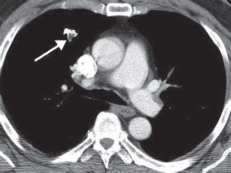 Solitary And Multiple Pulmonary Nodules Radiology Key