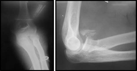 Scielo Brasil Terrible Triad Of The Elbow Evaluation Of Surgical