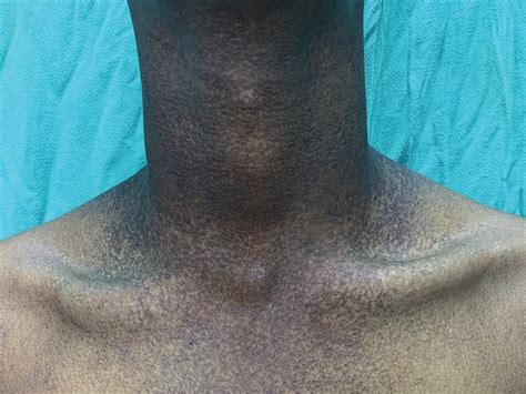 Reticulate Pigmentation Over Anterior Chest And Neck Download