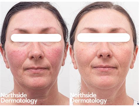 Rosacea And Redness Skin Treatment Specialists In Melbourne