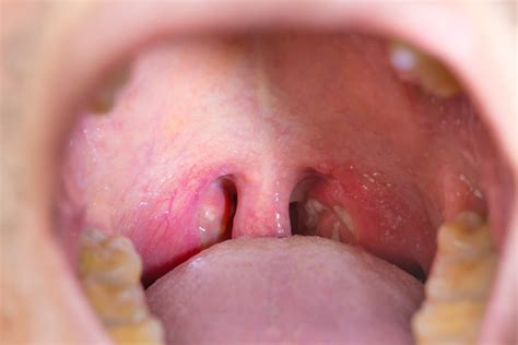 White Spot On Tonsils Causes And How To Get Rid Of These White Spots