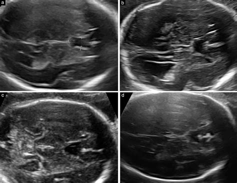 Cavum Septi Pellucidi CSP Ratio A Marker For Partial Agenesis Of The