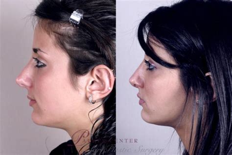 Rhinoplasty Before And After Pictures Case 140 Paramus Nj Parker