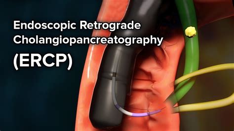 Endoscopic Retrograde Cholangio Pancreatography ERCP Yashoda Hospital
