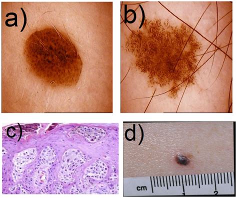 Picture Of A Nevus Presenting Regular Border B Picture Of A