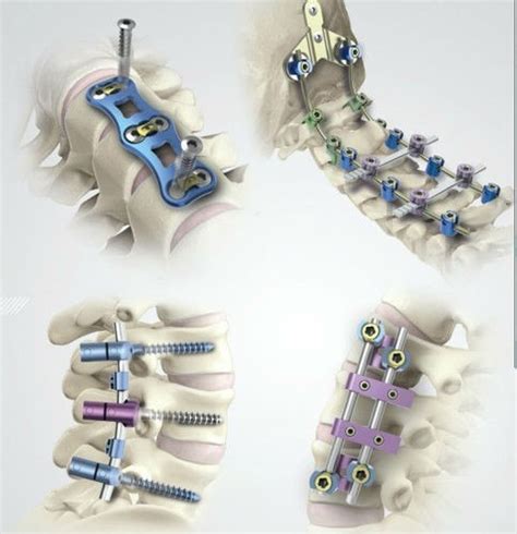Spinal Implants And Surgery Devices Market Is Segmented Into Open
