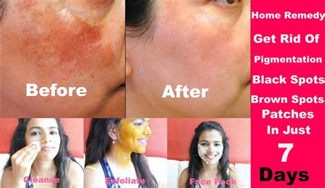 Remove Pigmentation Easily How To Remove Black Spots And Dark Spots