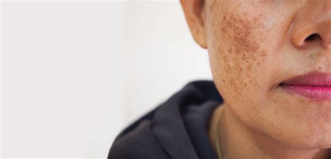 Hyperpigmentation Treatment Drbk Clinic In Reading Berkshire