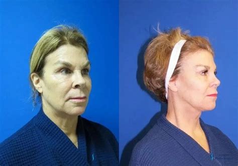Facelift And Neck Lift Before And After Pictures Patient 2