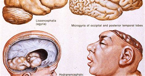 Neuropathology Blog Brain Malformations