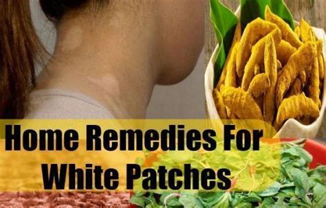 How To Get Rid Of White Spots On Skin With Home Remedies A Person May