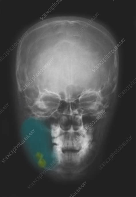Dentigerous Bone Cyst X Ray Stock Image C0272628 Science Photo